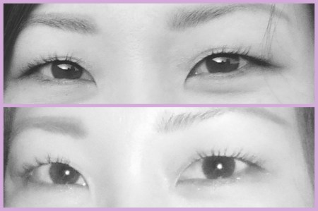 03 After Careprost - Review