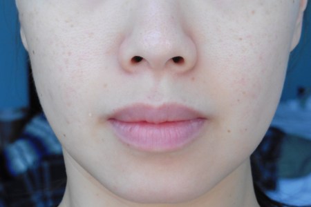 04 Day 1 - Before PocketDerm Anti-Aging